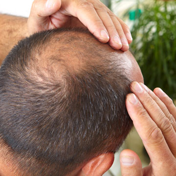 Kto jest narażony na genetyczne łysienie?