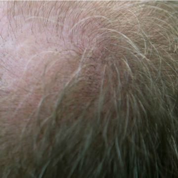 Onkologia: Czepki na wypadanie włosów
